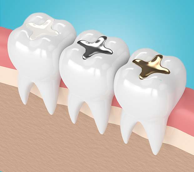 Arlington Composite Fillings