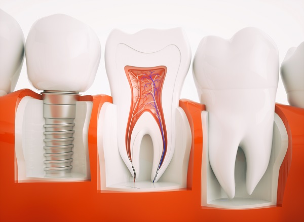 All-on-4 Dental Implants Arlington, TX