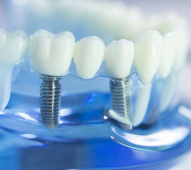 Arlington Dental Implants