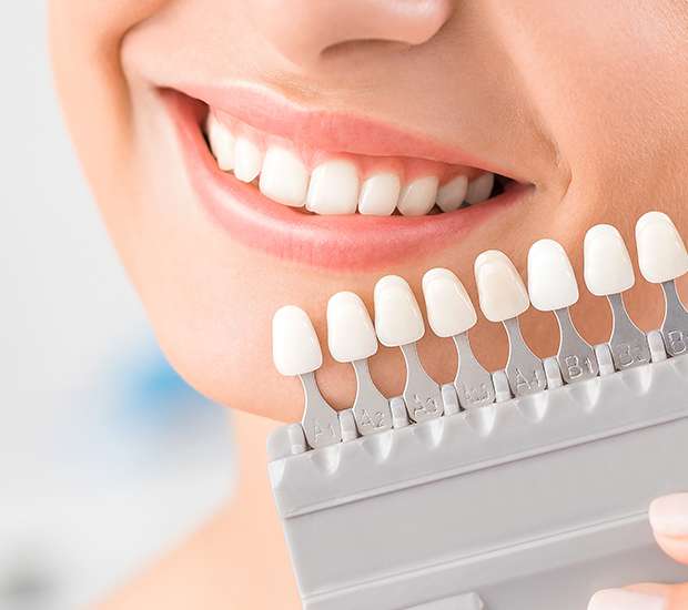 Arlington Dental Veneers and Dental Laminates