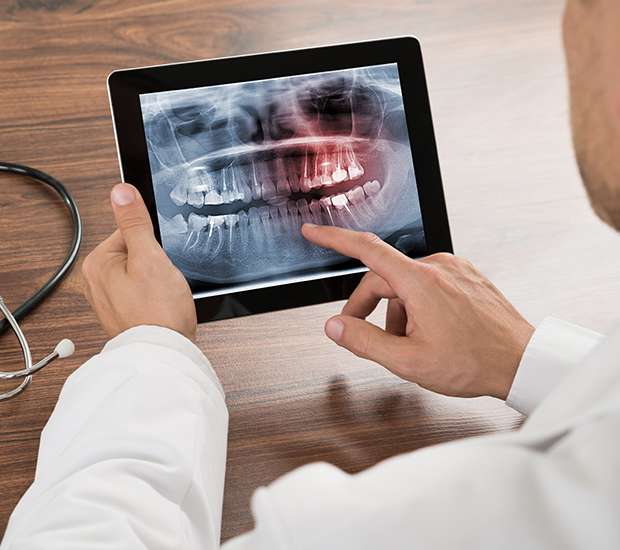 Arlington Types of Dental Root Fractures